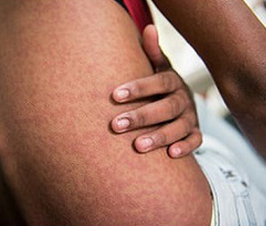 El virus del Chikungunya